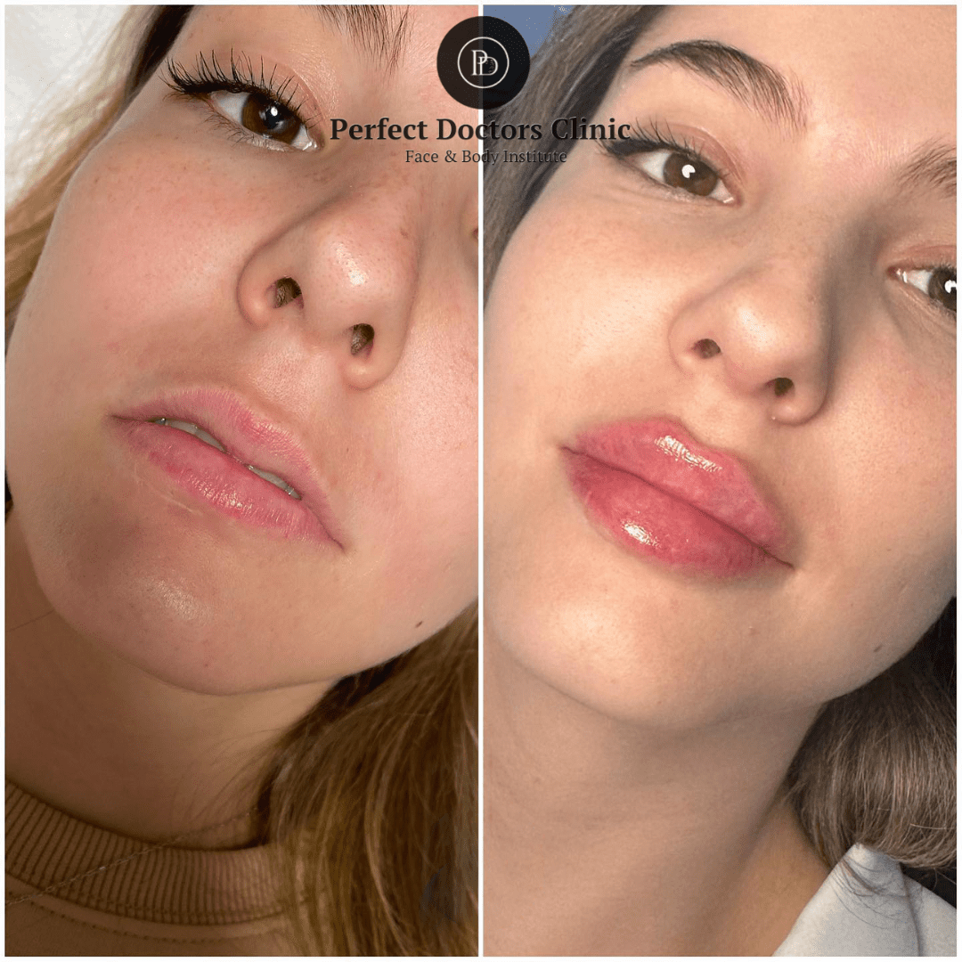 Pain Levels During Juvederm Treatments in Dubai