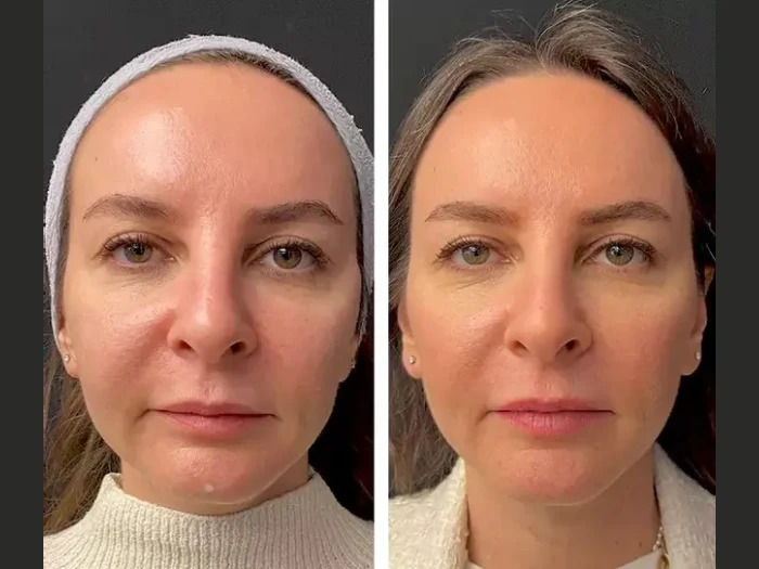 Best Doctors in dubai for Hair Mesotherapy: Expert Care Explained