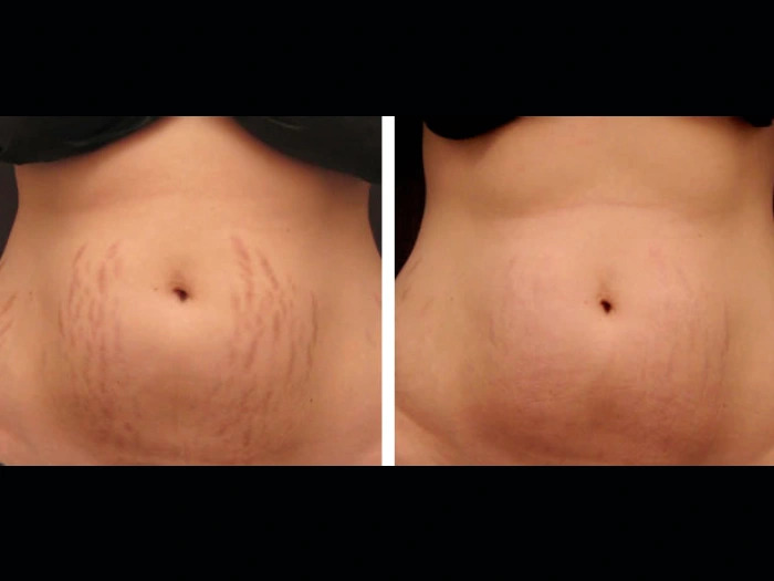 Radiance Restored by Radiofrequency (RF) Microneedling Best Doctors in dubai