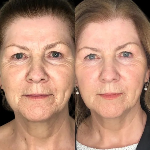 Skin Quality Moves Up with Profhilo and Best Doctors in dubai