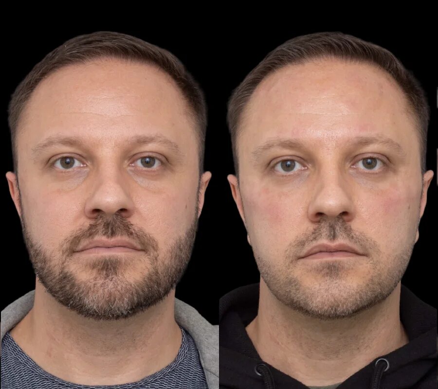 Best Doctors in dubai Guide to Natural Under Eye Fillers Results