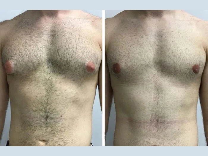 Why Patients Trust Best Doctors in Dubai for Gynecomastia Care