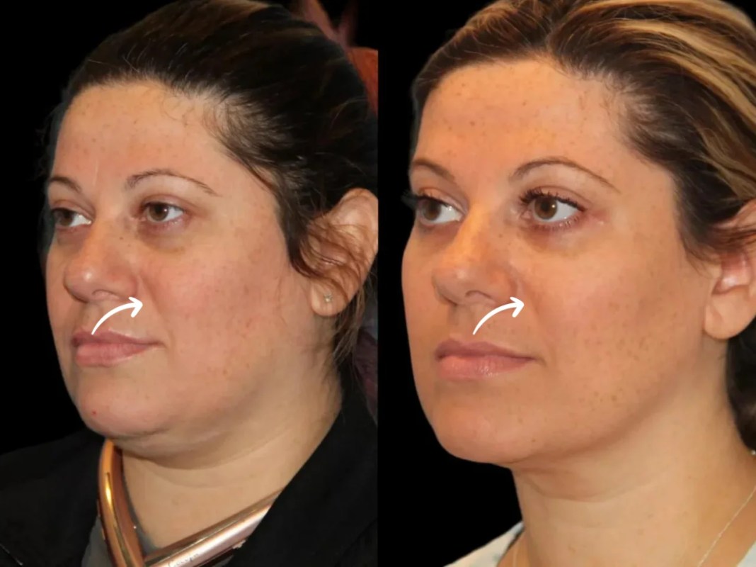 Sculptra Treatments in Dubai for Brow Bone Aging