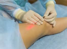 Laser Treatment for Varicose Veins: A Modern, Painless Solution