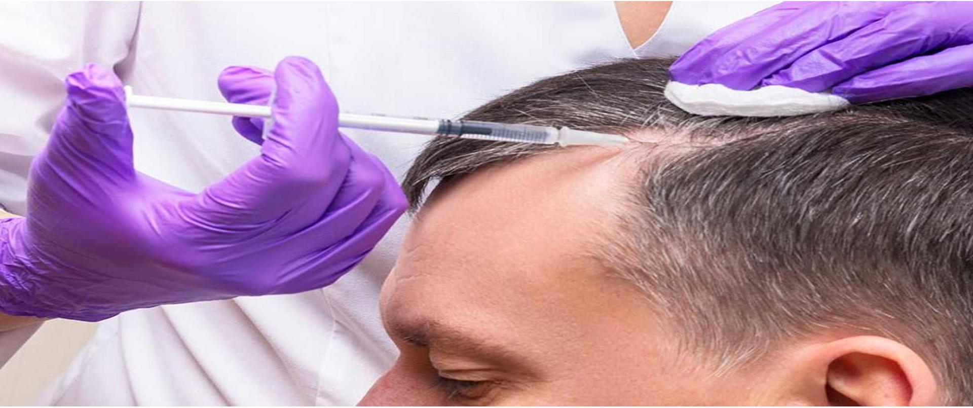 PRP for Hair Loss: Effective Method for Hair Strengthening