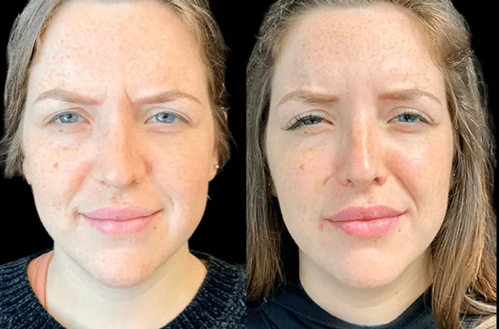 Botox Treatments in Dubai: Trends Shaping the Aesthetic Industry