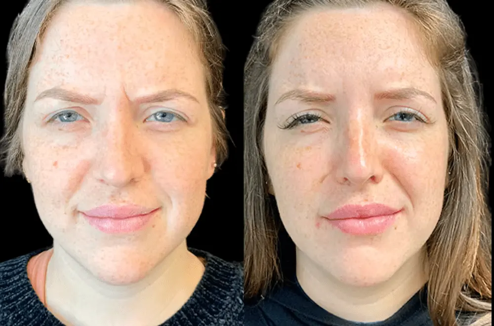 How Long Do Results Last? A Complete Guide to Botox Treatments in Dubai