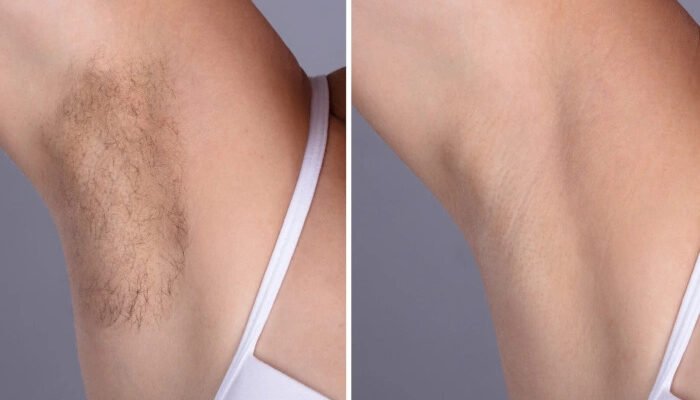 Best Doctors in Dubai Setting New Standards in Laser Hair Removal
