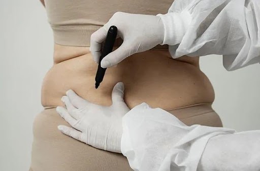 Plan Abdominoplasty in Bangalore with the Right Specialists: A Complete Guide